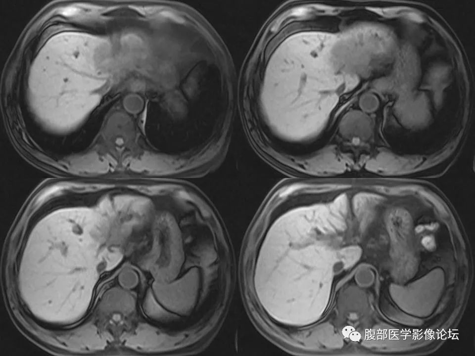 Cholangiocarcinoma: Insights and Clinical Perspectives