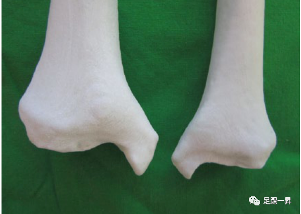 Application of 3D Printing Technology in Complex Tibial Fractures