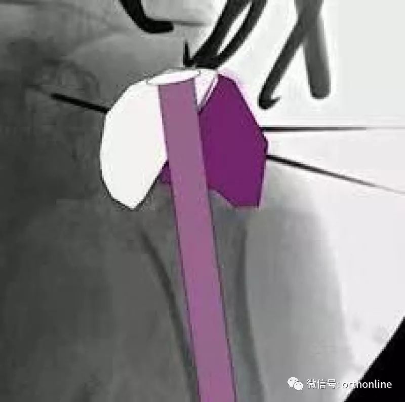 Introduction and Resetting Tips for Proximal Humerus Multilock Intramedullary Nail