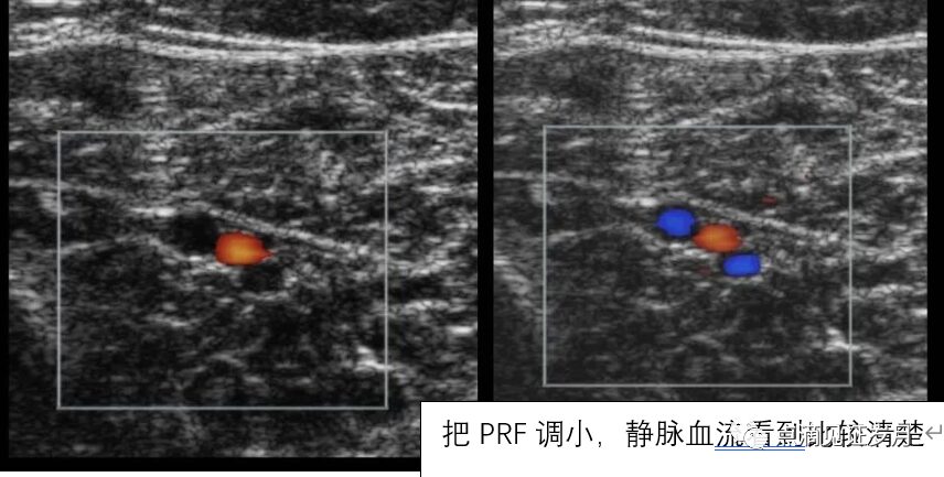 Understanding and Adjusting Parameters of Color Doppler Ultrasound Machines