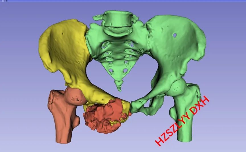 AI and Medical Imaging Fusion Modeling with 3D Printing for Precise Bone Tumor Resection