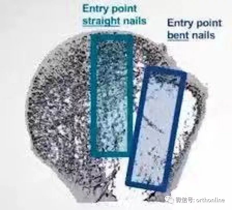 Introduction and Resetting Tips for Proximal Humerus Multilock Intramedullary Nail