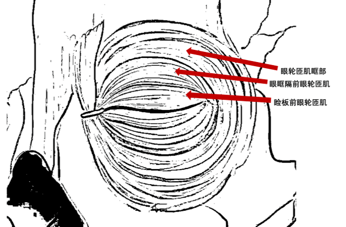 Understanding Blepharospasm and Apraxia of Eyelid Opening in PSP Patients