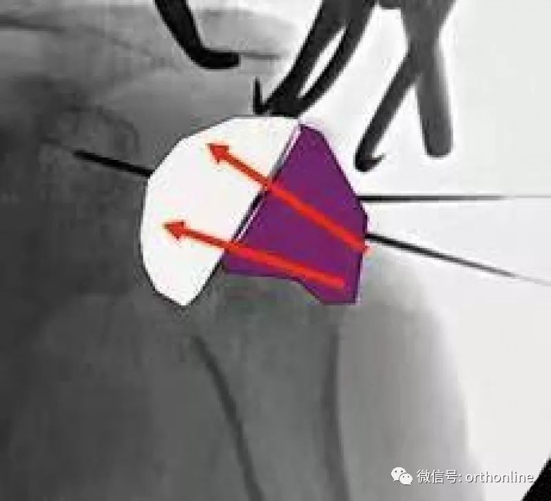 Introduction and Resetting Tips for Proximal Humerus Multilock Intramedullary Nail