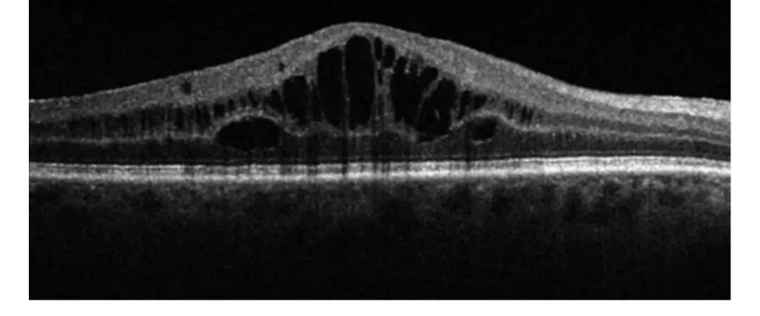 How to Identify Macular Edema in OCT Examination