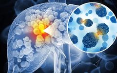 Overview of Diagnosis and Staging of Primary Liver Cancer
