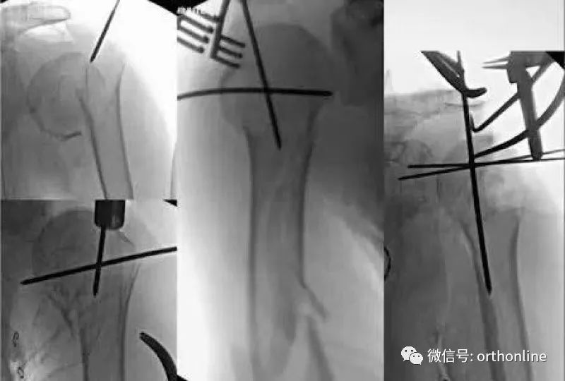 Introduction and Resetting Tips for Proximal Humerus Multilock Intramedullary Nail