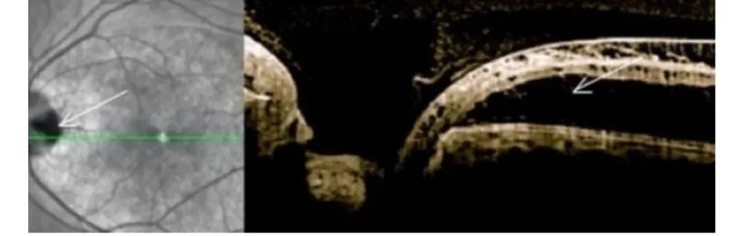 How to Identify Macular Edema in OCT Examination