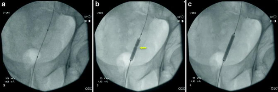 Ureteroscopic Access: Sheaths, Balloons, and Wireless Approaches