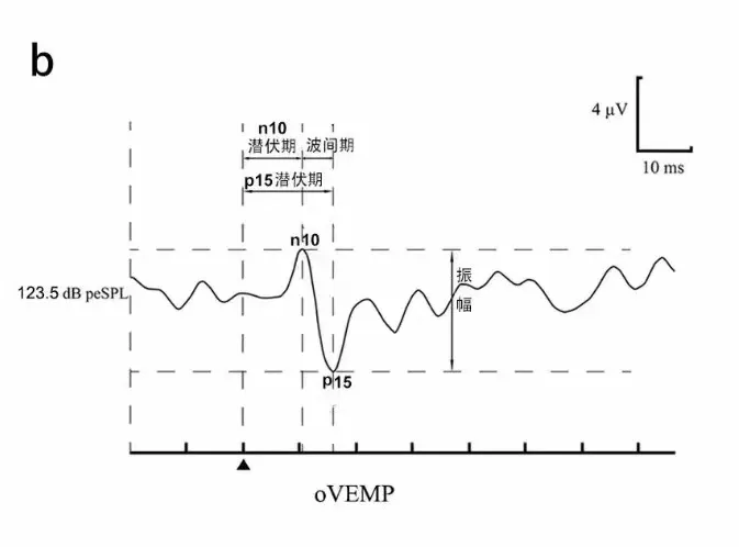 Clinical Practice Consensus on Vestibular Evoked Myogenic Potentials in China (2024)