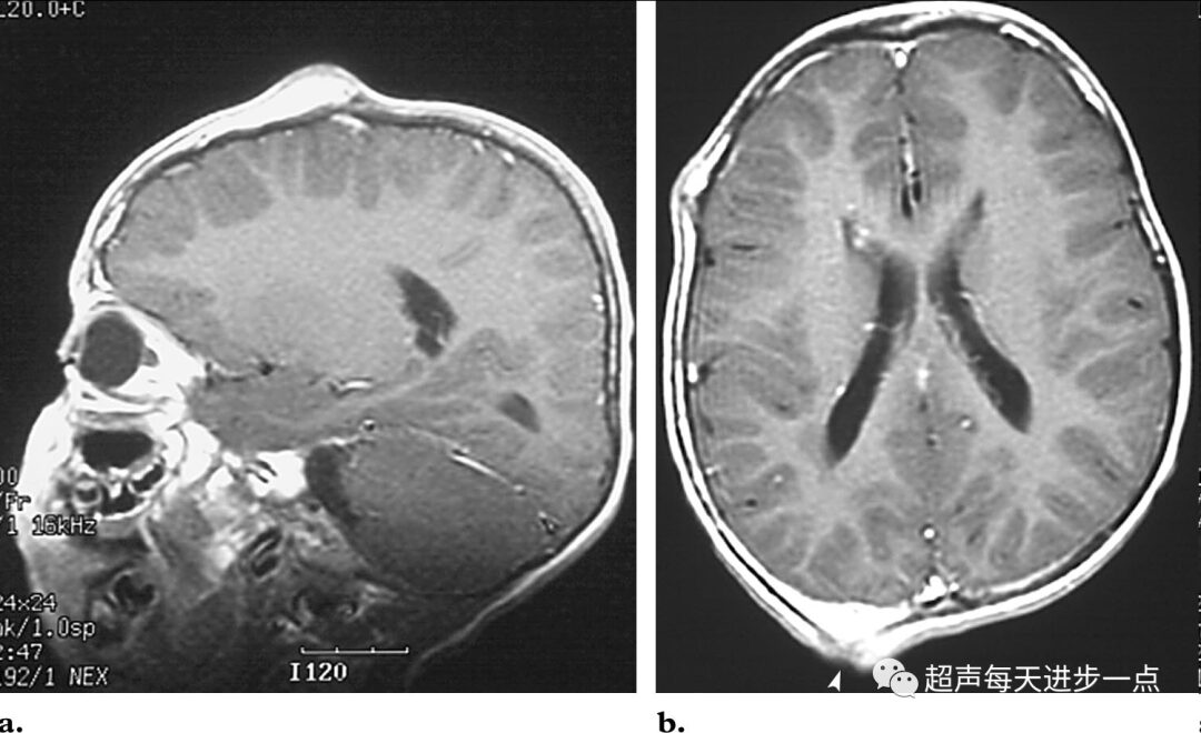 Proteus Syndrome: Characteristics and Diagnosis