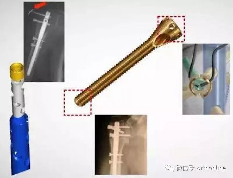 Introduction and Resetting Tips for Proximal Humerus Multilock Intramedullary Nail