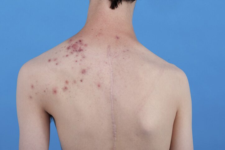 Professor Zhang Jianzhong's Guide To Acne Along Blaschko Lines In Proteus Syndrome
