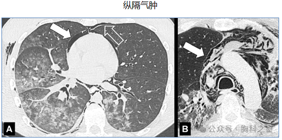 Compilation of Chest Imaging Terminology (IV)