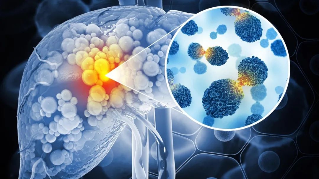 Overview of Diagnosis and Staging of Primary Liver Cancer