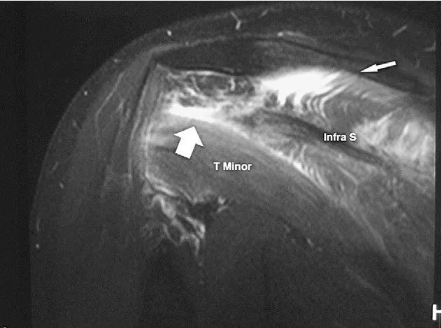 What We Should Know About the Infraspinatus Muscle