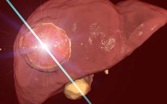 Diagnosis and Staging of Primary Liver Cancer