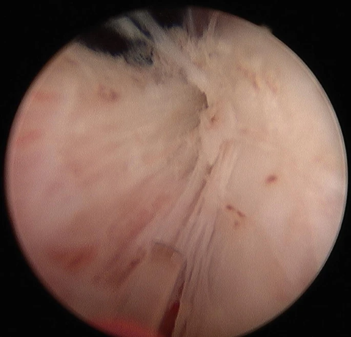 HoLEP Procedure Steps and Techniques