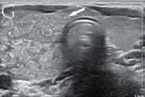 Which Thyroid Nodules Require Surgical Removal? Exploring C-TIRADS Classification