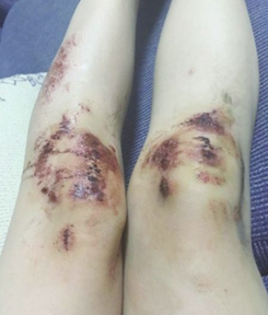 The Great Uses of Vitamin C in Treating Injuries