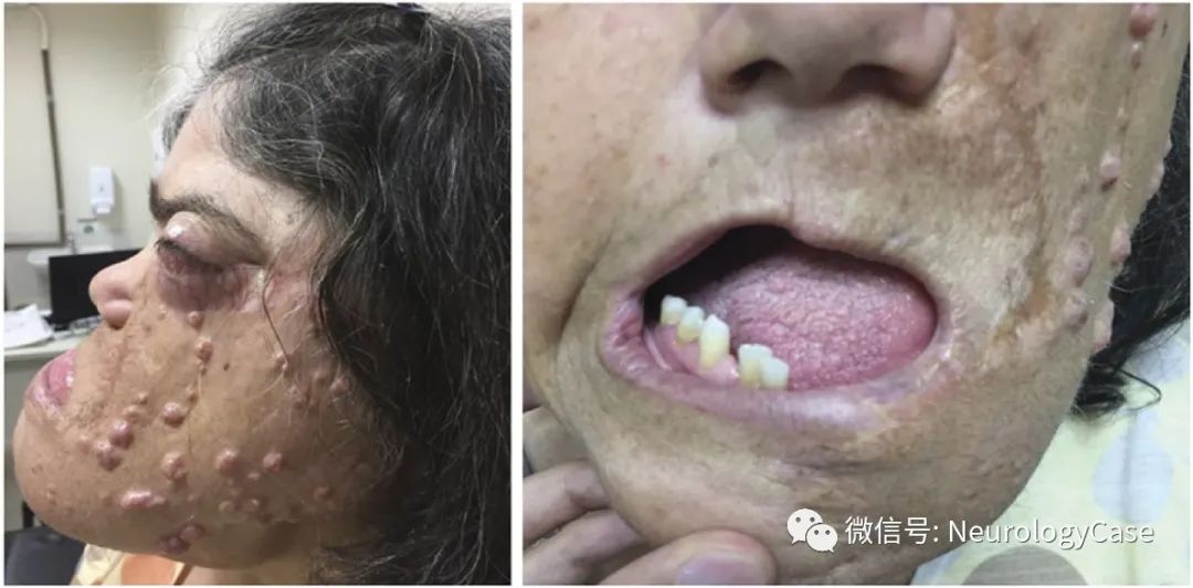 Clinical And Neuroimaging Features Of Encephalocraniocutaneous Lipomatosis