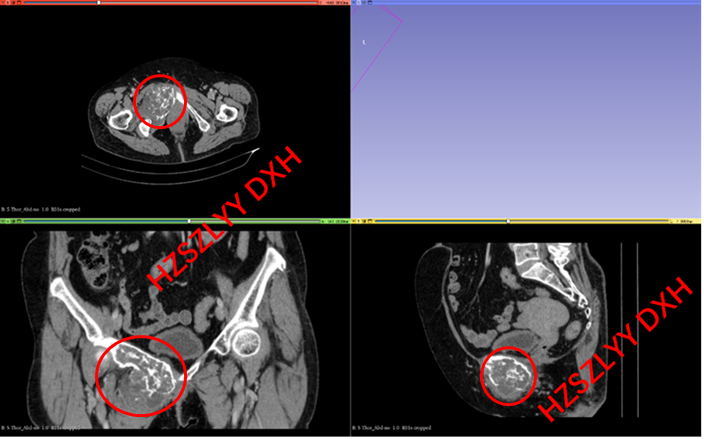 AI and Medical Imaging Fusion Modeling with 3D Printing for Precise Bone Tumor Resection