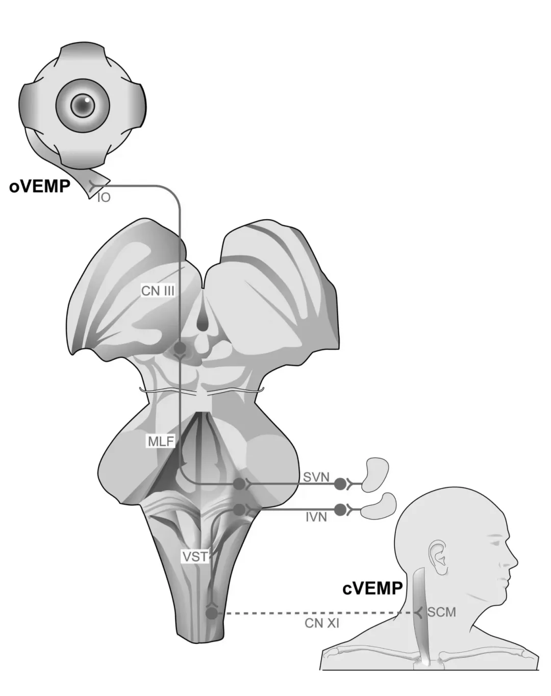 Clinical Practice Consensus on Vestibular Evoked Myogenic Potentials in China (2024)