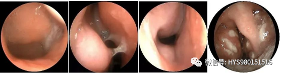 The Past And Present Of Secretory Otitis Media In Children