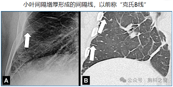 Compilation of Chest Imaging Terminology (IV)