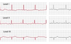 Mastering Smartwatches: Transforming Into An ECG Machine