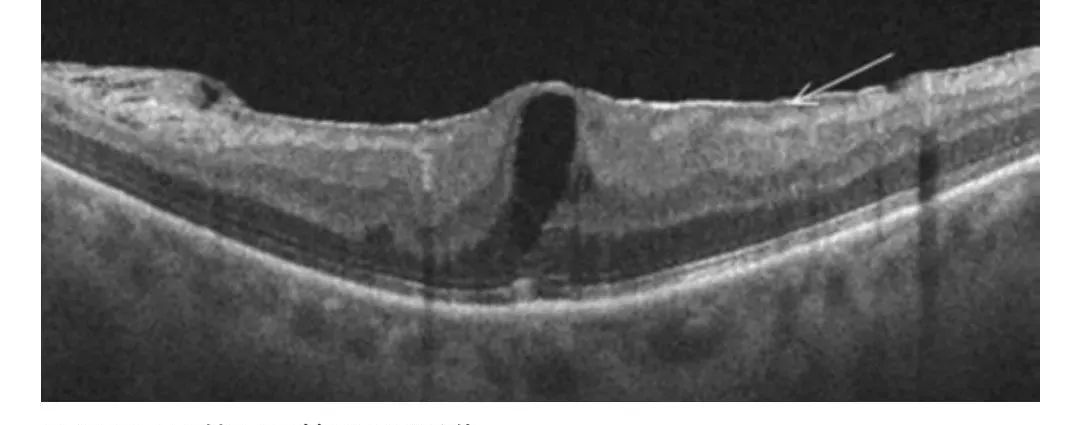 How to Identify Macular Edema in OCT Examination