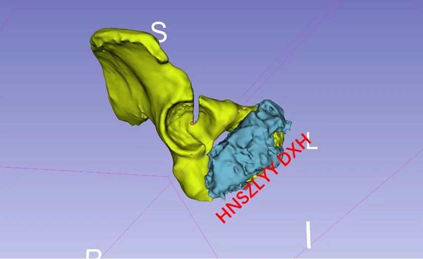AI and Medical Imaging Fusion Modeling with 3D Printing for Precise Bone Tumor Resection