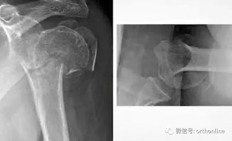 Introduction and Resetting Tips for Proximal Humerus Multilock Intramedullary Nail
