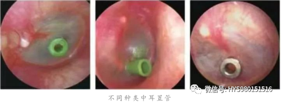 The Past And Present Of Secretory Otitis Media In Children