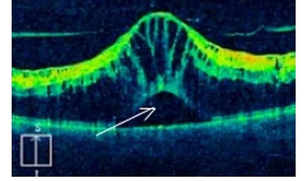 How to Identify Macular Edema in OCT Examination