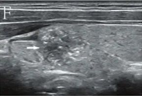 Which Thyroid Nodules Require Surgical Removal? Exploring C-TIRADS Classification