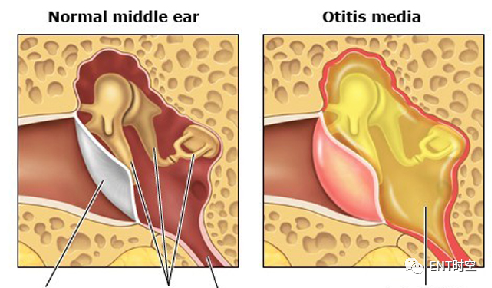 Diagnosis and Treatment of Adenoid Hypertrophy and Complications