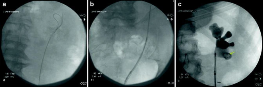 Ureteroscopic Access: Sheaths, Balloons, and Wireless Approaches