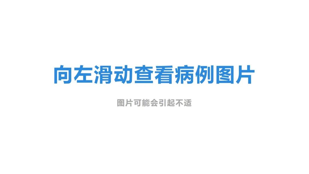 Professor Zhang Jianzhong's Guide To Acne Along Blaschko Lines In Proteus Syndrome