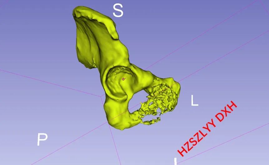 AI and Medical Imaging Fusion Modeling with 3D Printing for Precise Bone Tumor Resection
