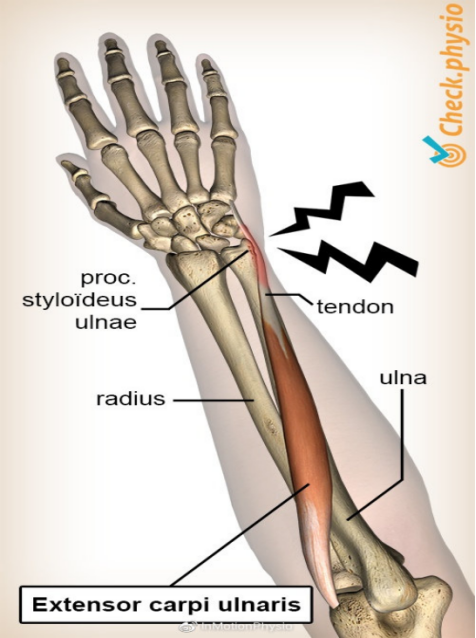 Common Factors for Ulnar-Sided Wrist Pain in Athletes