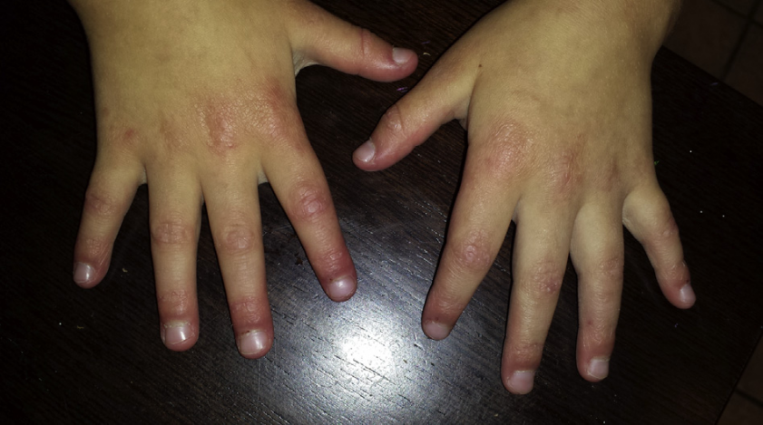 Understanding NXP2 Positive Juvenile Dermatomyositis