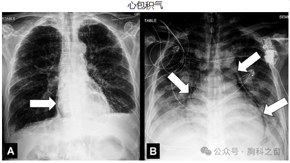 Compilation of Chest Imaging Terminology (IV)