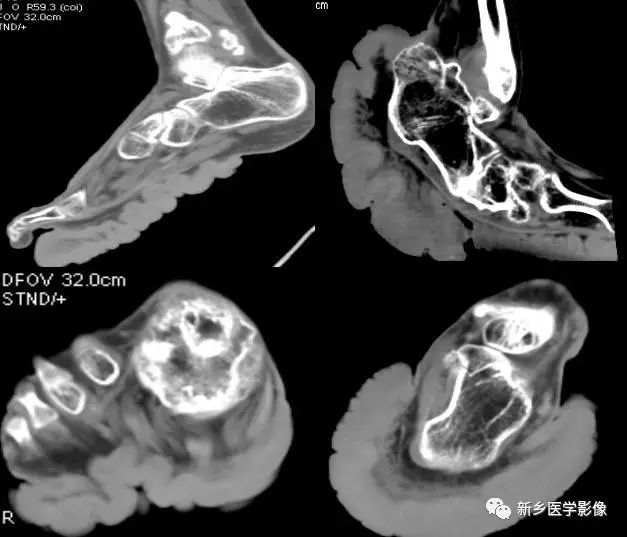 Overview of Proteus Syndrome