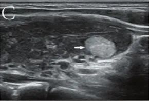 Which Thyroid Nodules Require Surgical Removal? Exploring C-TIRADS Classification