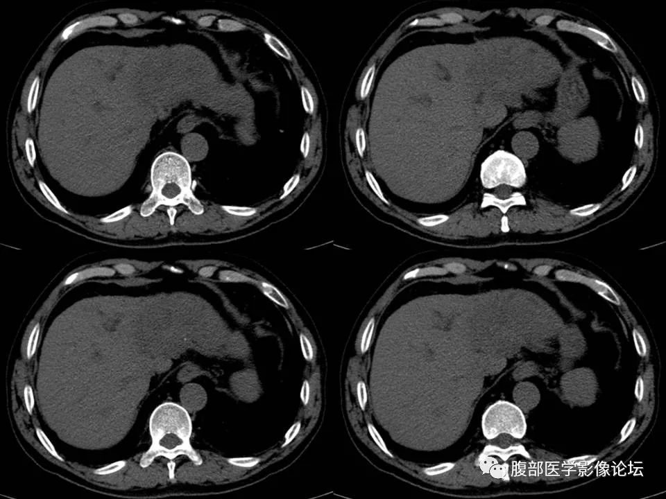 Cholangiocarcinoma: Insights and Clinical Perspectives