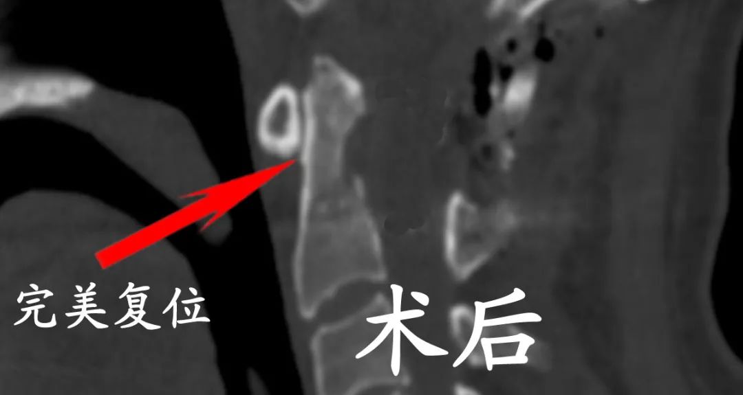 3D Printing Bones: Turning Virtual into Reality
