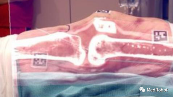 Overview of 5 Orthopedic Navigation and Surgical Robots