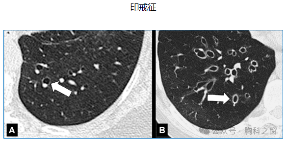 Compilation of Chest Imaging Terminology (IV)