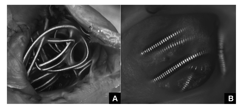 Using Other Stones to Polish Jade: Insights on LAAC Residual Leak Management
